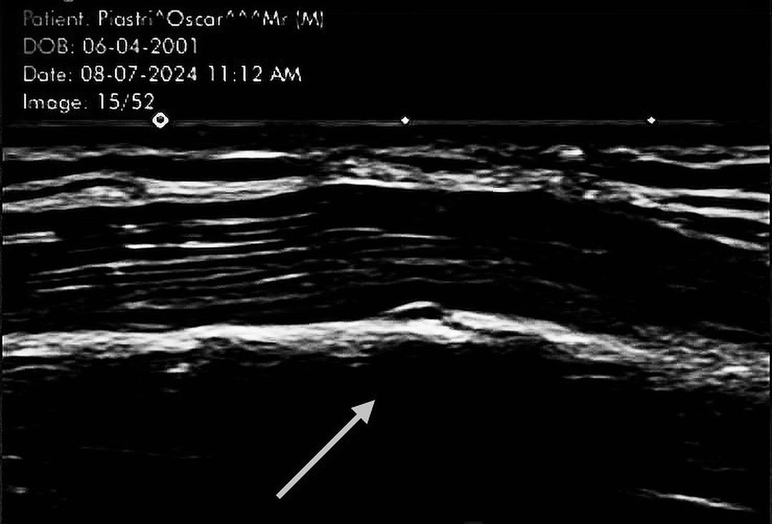 ‘Very special talent’ Piastri reveals ‘first broken bone’ in F1